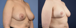 Breast Reduction B&A 5B