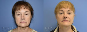 Facelift/Neck Lift B&A 1A