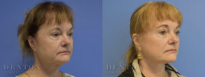 Facelift/Neck Lift B&A 1B