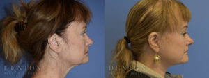 Facelift & Neck lift Patient 1-C: Before & After