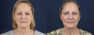 Facelift/Neck Lift B&A 2A