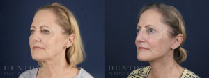 Facelift/Neck Lift B&A 2B