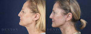 Facelift/Neck Lift B&A 2C