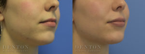 Lip Augmentation Revision B&A 1B