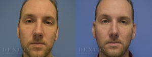 Septoplasty/Rhinoplasty B&A 1A