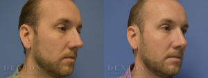 Septoplasty/Rhinoplasty B&A 1B