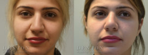 Septoplasty/Rhinoplasty B&A 2A