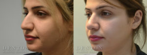 Septoplasty/Rhinoplasty B&A 2B