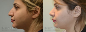 Septoplasty/Rhinoplasty B&A 2C