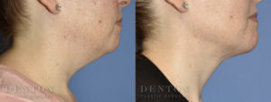 Submental Liposuction B&A 1A