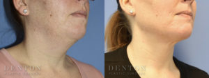 Submental Liposuction B&A 1B