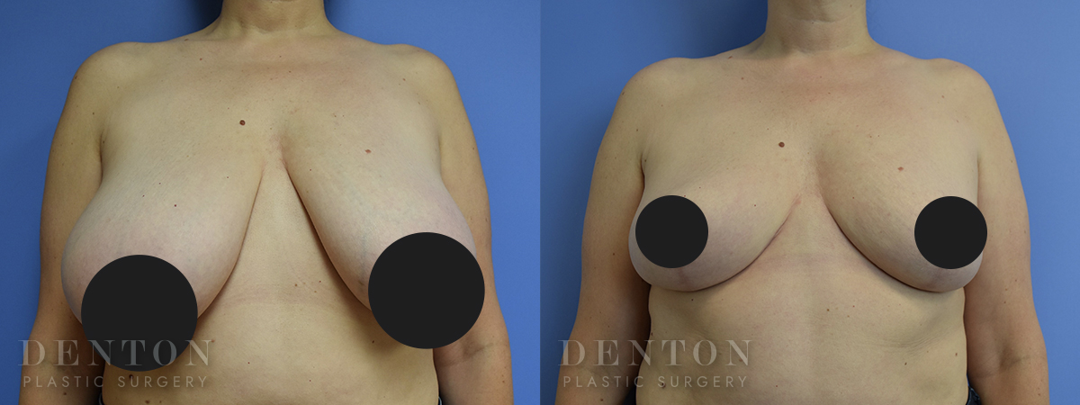 breast Aug