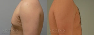 Gynecomastia B&A 11123A