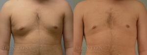 Gynecomastia B&A 11123B