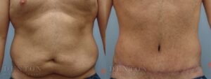 Tummy Tuck B&A 03B