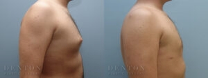 Gynecomastia B&A 14507A