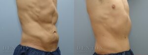 Tummy Tuck B&A 04A