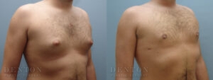 Gynecomastia B&A 14507B