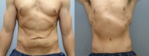 Tummy Tuck B&A 04B