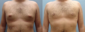 Gynecomastia B&A 14507C