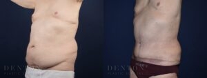 Tummy Tuck B&A 02A