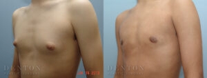 Gynecomastia B&A 17743A