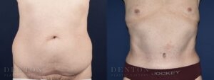 Tummy Tuck B&A 02B