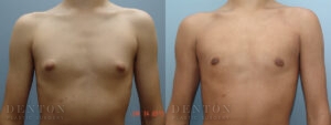 Gynecomastia B&A 17743B