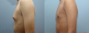 Gynecomastia B&A 17743C