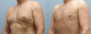 Gynecomastia B&A 05A