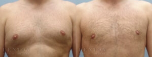 Gynecomastia B&A 05B