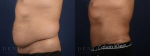 Tummy Tuck B&A 01C