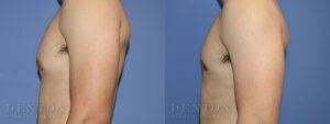 Gynecomastia B&A CJ05A