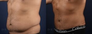 Tummy Tuck B&A 01D