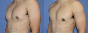 Gynecomastia B&A CJ05B