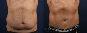 Tummy Tuck B&A 01E