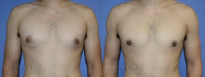 Gynecomastia B&A CJ05C