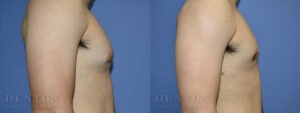 Gynecomastia B&A CJ05D