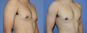 Gynecomastia B&A CJ05E