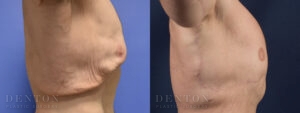 Gynecomastia B&A G07A