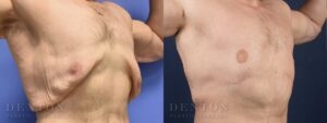 Gynecomastia B&A G07B