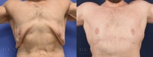 Gynecomastia B&A G07C