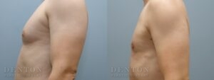 Gynecomastia B&A 20123A