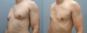 Gynecomastia B&A 20123B