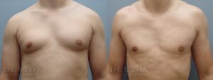 Gynecomastia B&A 20123C