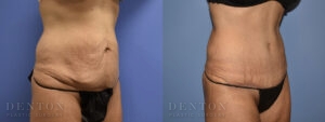 Tummy Tuck B&A 09B