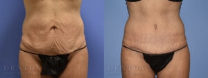 Tummy Tuck B&A 09C