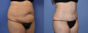 Tummy Tuck B&A 03B