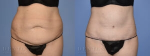 Tummy Tuck B&A 03C