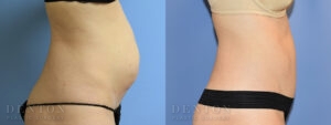 Tummy Tuck B&A 04-02A